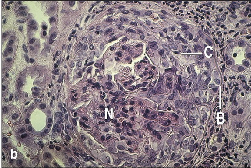 <p>This stain is from what disease</p>