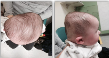 <p>Asymmetric and disproportionate - </p><ul><li><p>combined asymmetric and disproportional deformity </p></li><li><p>MOST COMMON TYPE </p></li><li><p>hybrid of DP and DB</p></li><li><p>bilateral occipital flattening, with increased flattening on one side crossing midline </p></li><li><p>prominences at the posterior parietal and the lateral parietal </p></li><li><p>frontal asymmetry and/or bossing may be present </p></li><li><p>facial asymmetry may be present </p></li></ul><p></p>