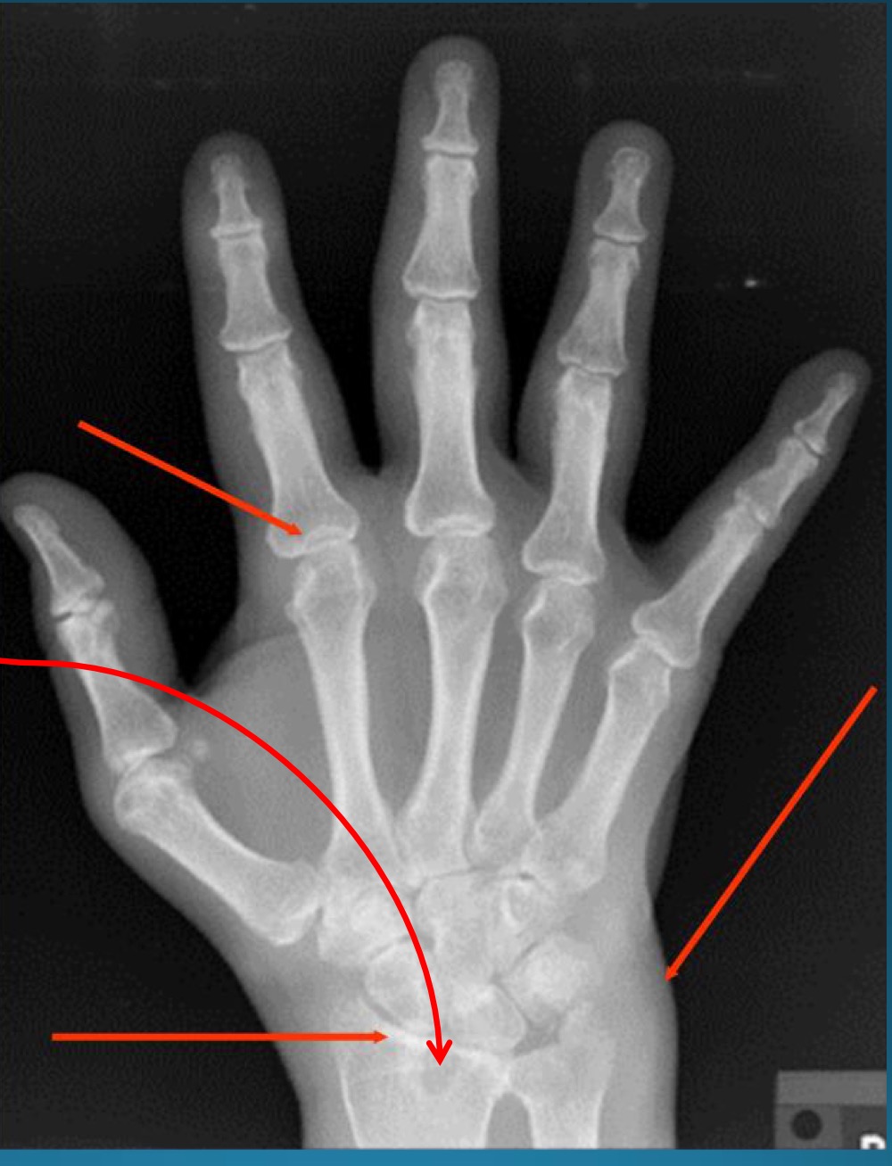 <p>red arrows are pointing to what feature? </p><p>part of what diagnosis?</p>