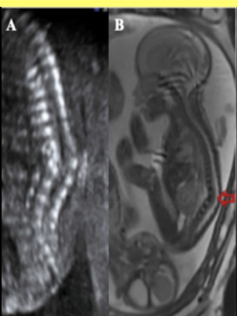 <p>which usually requires serial exams in the 2nd + 3rd trimester to make an accurate dx</p><p>a) kyphosis</p><p>b) corrected transposition of great arteries</p><p>c) complete transposition of great arteries</p><p>d) omphalocele </p>