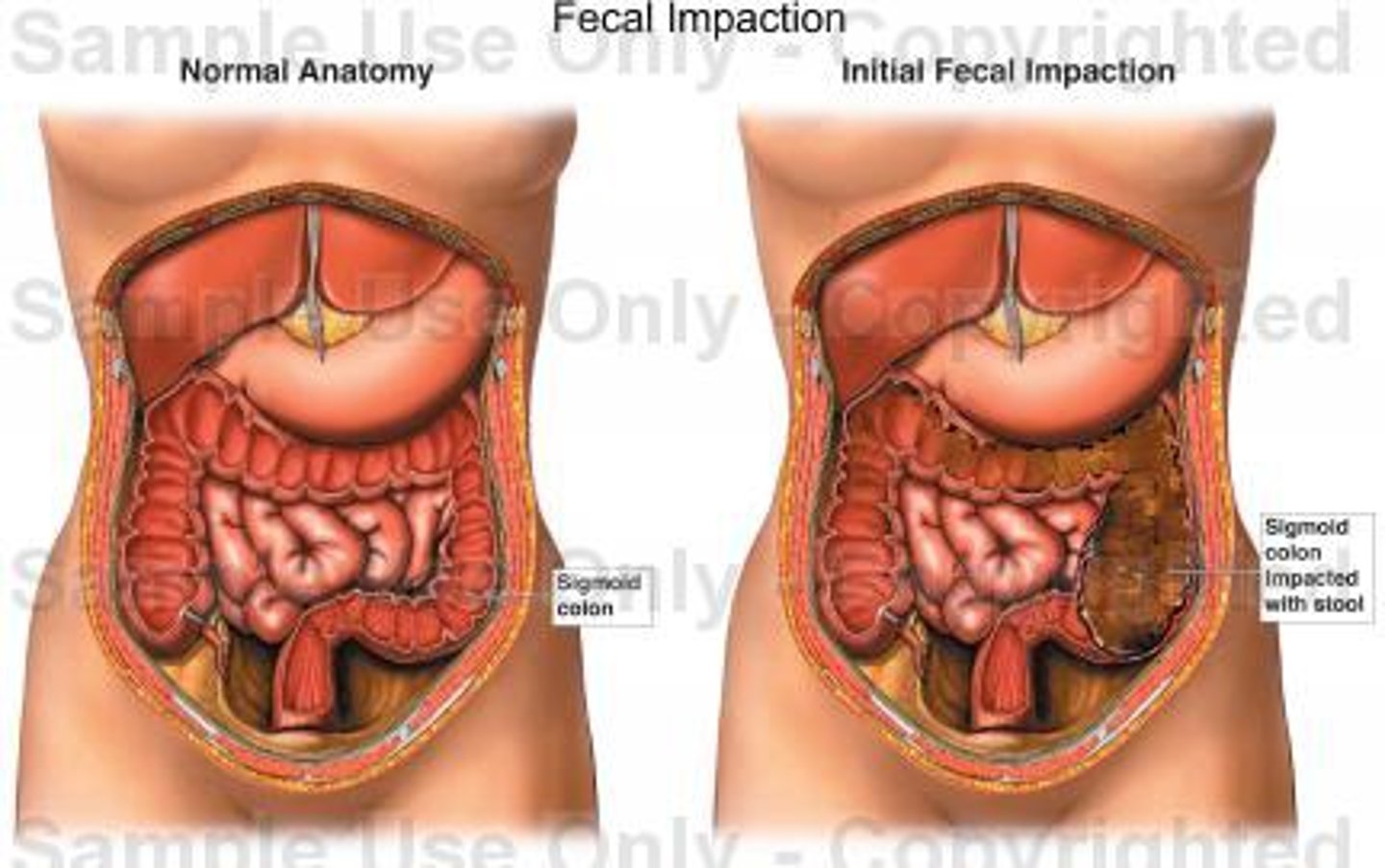 <p>hardened and dry feces in the folds of the rectum, resulting from prolonged retention and accumulation of fecal material</p>