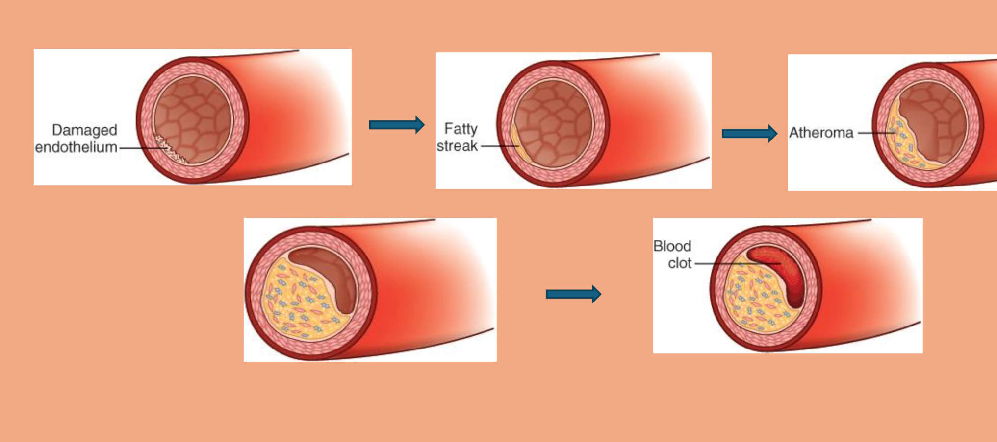 <p>atherosclerosis</p>