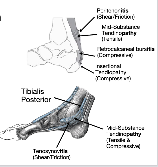 <ul><li><p>tendon comes together with other structures pressing on each other </p></li><li><p>more insertional achilles tendinopathy pressing against the calcaneus </p></li><li><p>tibilias posterior is a tendon typically exposed to compressive load as it goes thru the tarsal tunnel </p></li><li><p>rare in isolation </p></li><li><p><strong>Increased pain with stretch/excursion of the tendon</strong></p></li></ul><p></p>