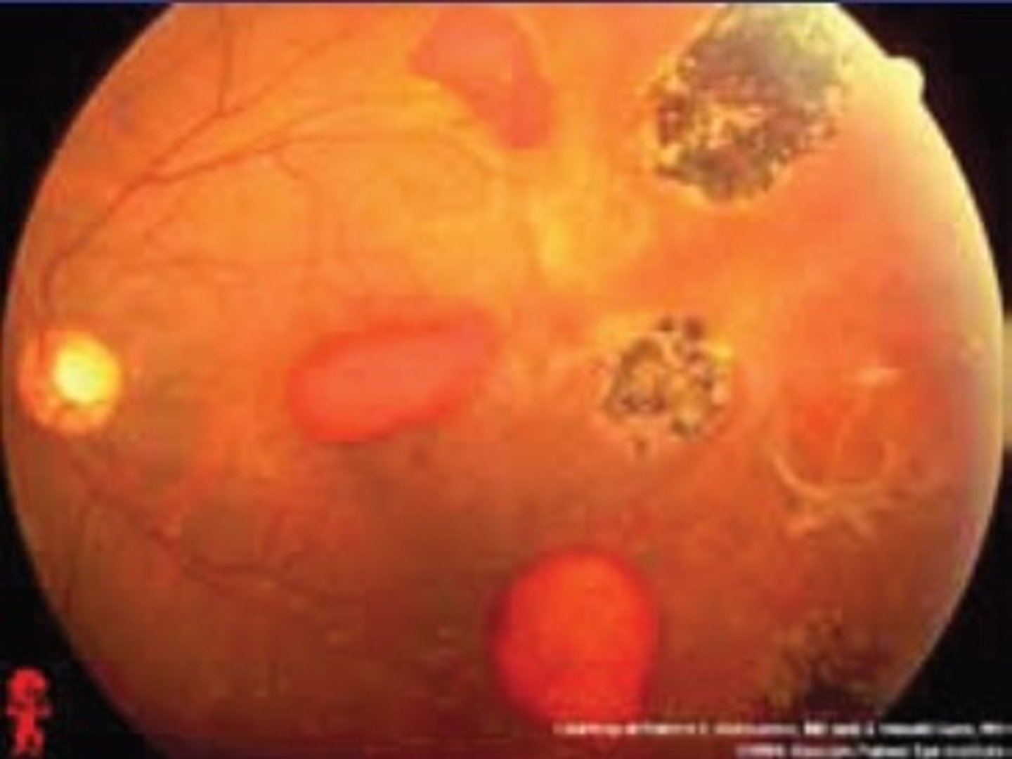 <p><u>Risk Factors</u>: Sickle Cell Disease</p><p><u>S&amp;S</u>: fundoscopic <strong>sea fan</strong>, <strong>salmon patches</strong> or black sunburst </p><p><u>Tx:</u> Prevent sickle crisis, emergent consult ophthalmologist</p>