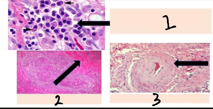<p>what are considered the classic microscopic features of chronic inflammation?</p>