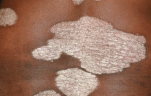 <p>large plateau-like elevation above the skin</p>