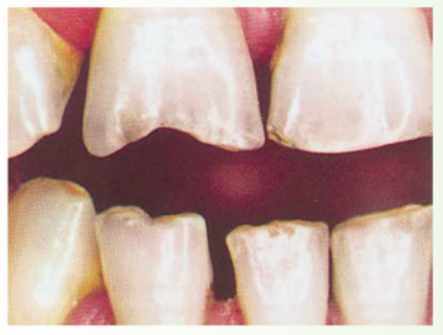 <p>biting surface abraded or notched with normal contours, sizing, spacing</p><p>recurrent trauma</p>