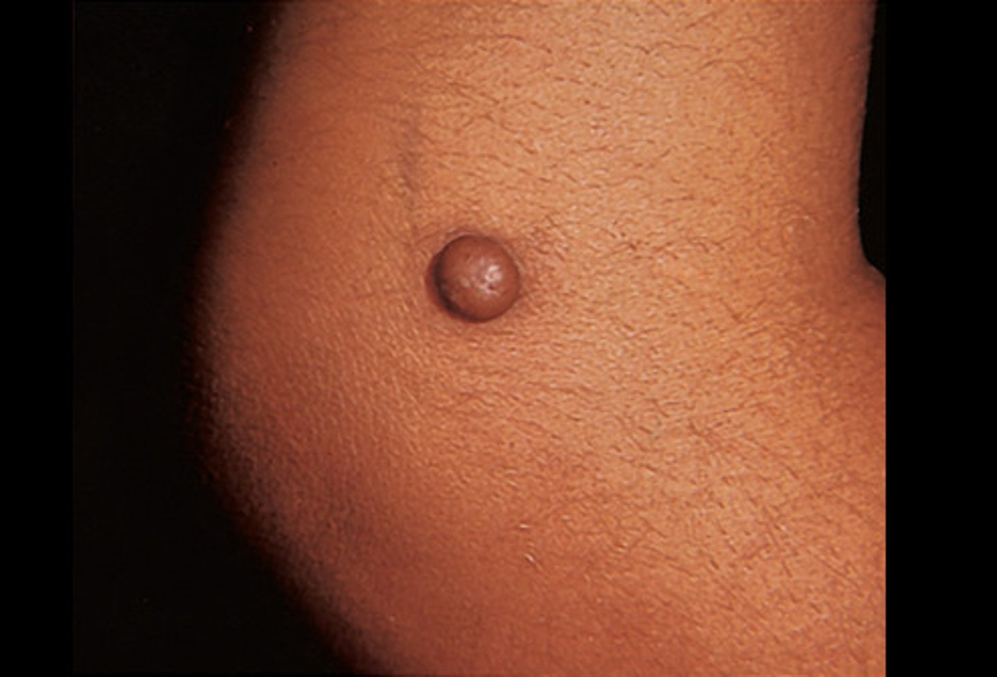 <p>diagnose this:</p><p>dome-shaped papules with firm consistency--> Erythematous, violaceous, or hyperpigmented</p>