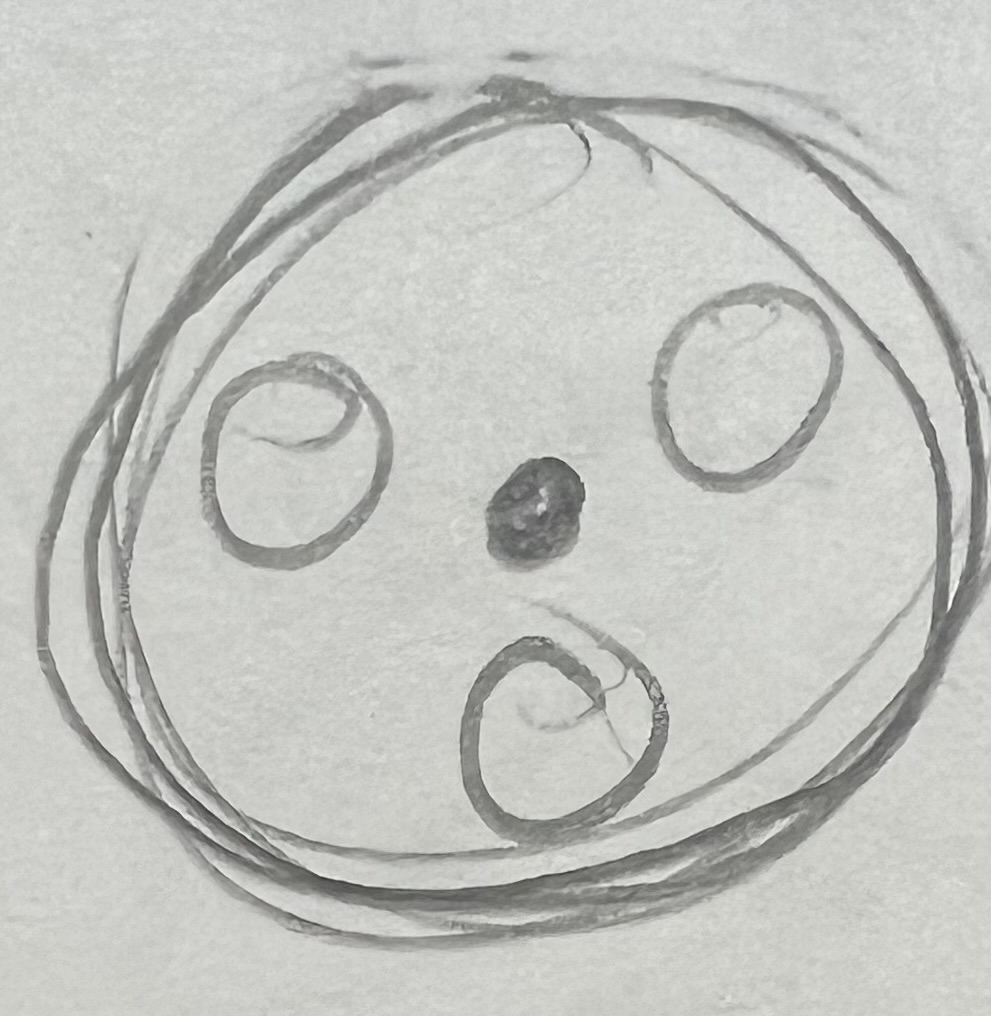 <ul><li><p>also bubble bc more specific lysosome</p></li></ul><p></p>