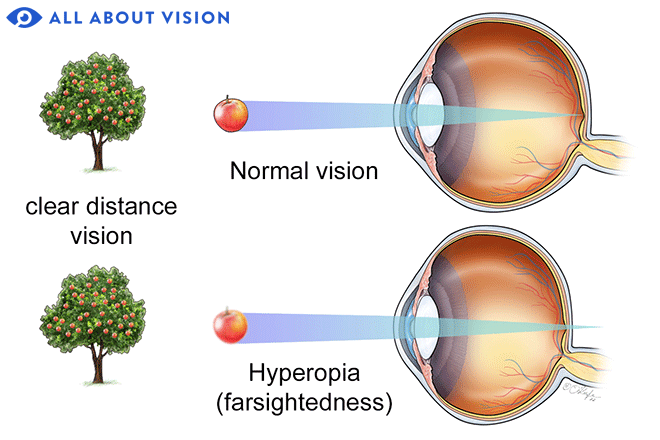 <p>Common vision condition in which far objects look clear but close objects look blurry</p><ul><li><p>Light goes too far and passes the back of the eye (retina)</p></li><li><p>Converging (convex lens</p></li></ul>