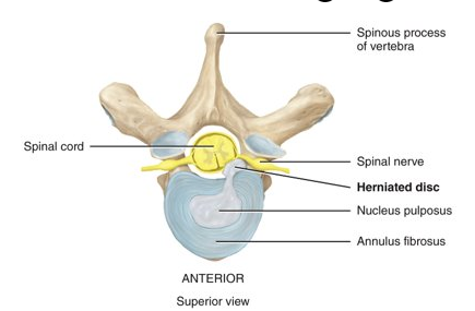 <p>may occur due to trauma or sometimes is simply associated with aging​</p>