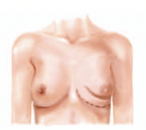 <p>Underdevelopment of lower medial and lateral quadrant of breast </p>