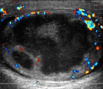 <p>The pathology seen here can be a complication of epididymo-orchitis and can have symptoms of swelling. What can be assumed here?</p>