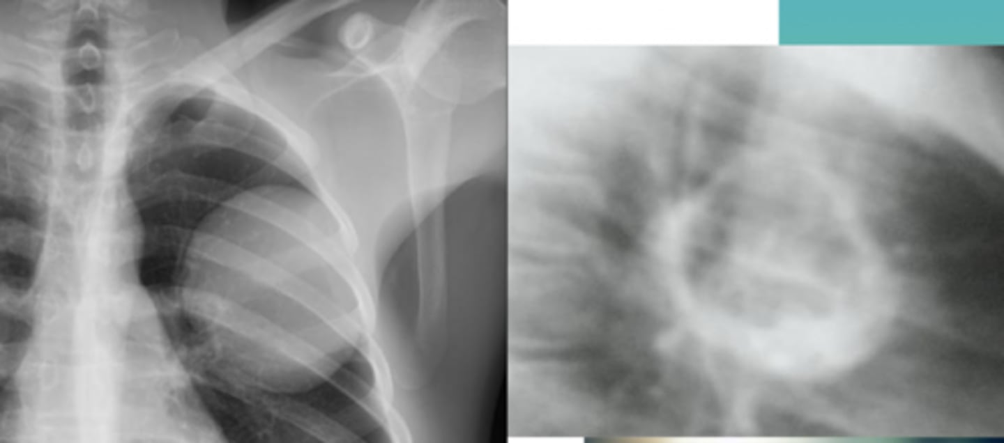 <p>A patient with close contact with dogs and livestock presents with a pulmonary mass lesion on imaging. Further evaluation shows possible spread from a primary hepatic lesion through the diaphragm. Chest imaging reveals a solid mass with possible cavitation, described as a “water lily” sign.</p>