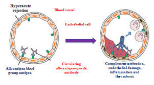 <p><strong>Hyperacute Rejection</strong></p><p class="MsoNormal">What is hyperacute rejection?</p>