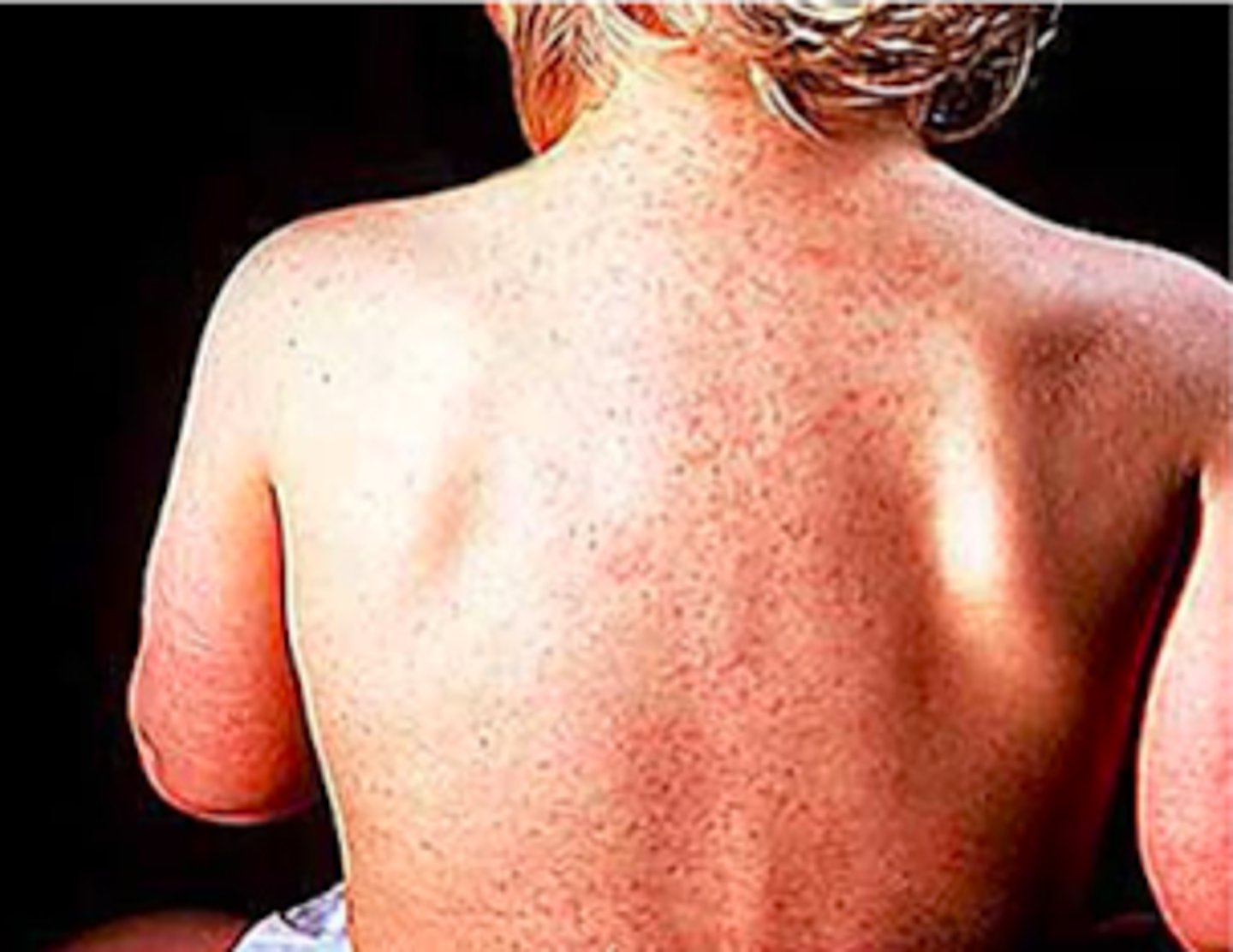 <p>Exanthems:</p><p>Objective:</p><p>Blanching macular or maculopapular rash</p><p>Starts on neck and trunk → face and extremities </p><p>Sometimes vesicular rash</p><p>Nonpruritic</p><p>Persists 1-2 days</p><p>Lymphadenopathy is common</p>