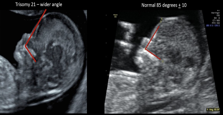 <p>fetal frontomaxillary facial (FMF) angle</p><p>a) is larger in normal fetuses than those w/aneuploidy</p><p>b) is measured in fetuses w/suspected trisomy 21</p><p>c) is measured after birth to see the true age of the fetus</p><p>d) should be measured on a fetus w/suspected cleft palate</p>