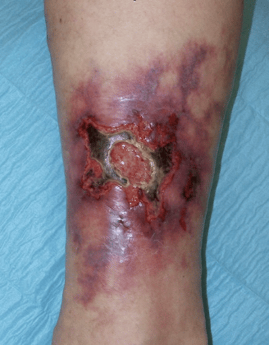 <p>HB: gallstones, primary sclerosing cholangitis (more common in UC), cholangiocarcinoma</p><p></p><p>Derm: erythema nodosum,<strong> pyoderma gangrenosum </strong></p><p></p><p>Oral: aphthous ulcers</p><p></p><p>Ocular: uveitis, iritis, episcleritis</p><p></p><p>MS: sacroilitis, arthropathy, AS, osteopenia</p>