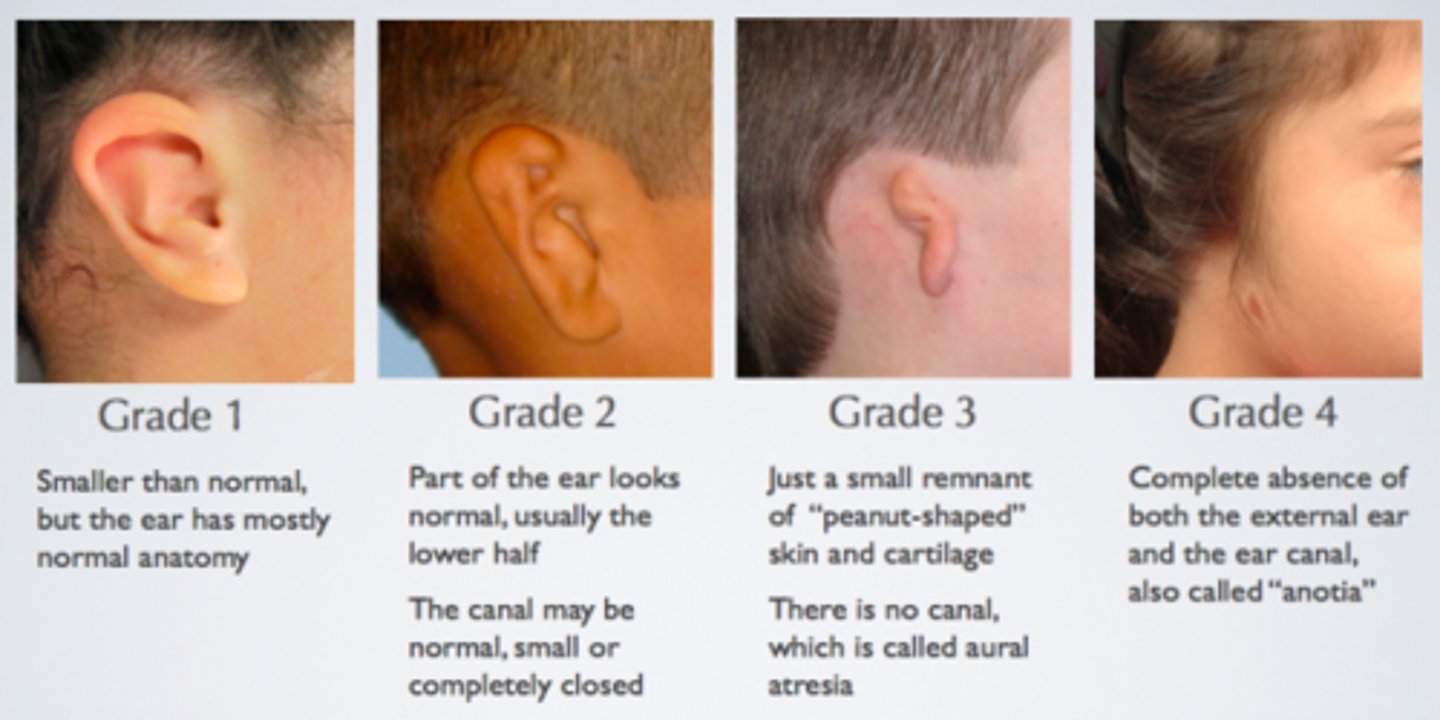 <p>congenital deformity where the pinna is underdeveloped (microtia) or completely absent (anotia)<br>anotia-pinna</p>