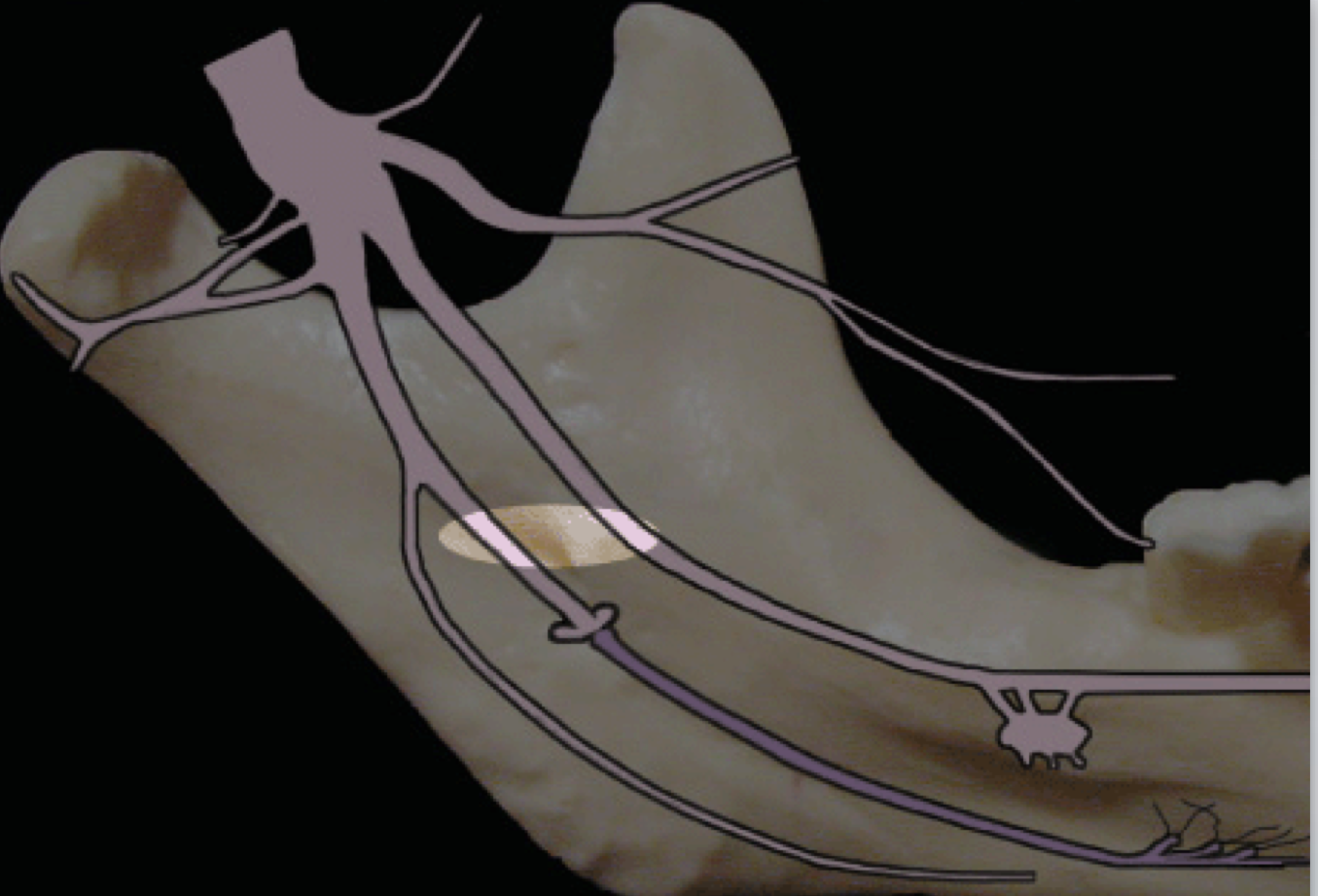 <p>Injection/Needle Target Site</p><ul><li><p>Same for inferior alveolar nerve block</p></li><li><p>Withdraw needle halfway after inferior alveolar nerve block and deposit local anesthetic solution</p></li></ul><p></p>
