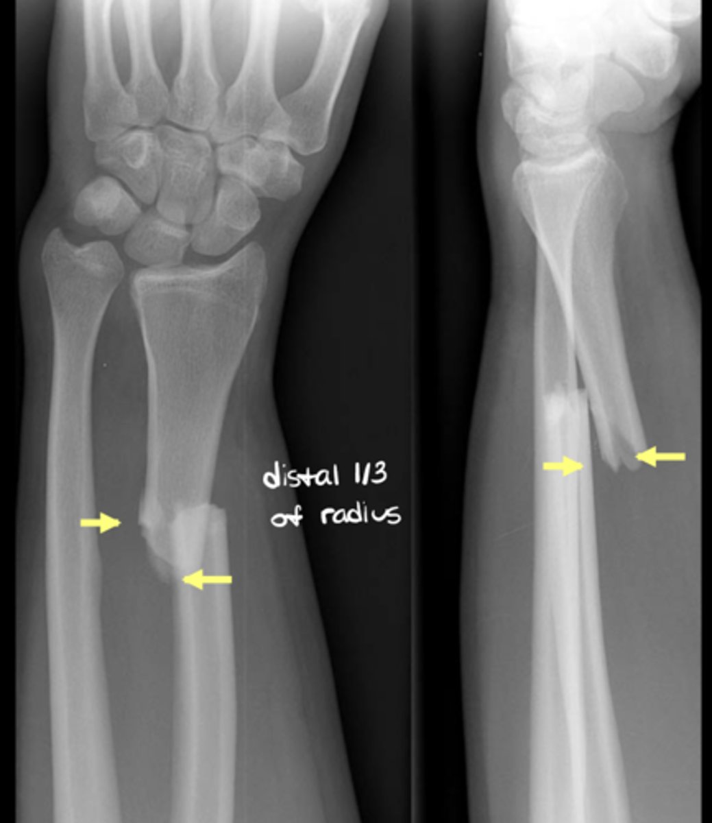 <p>All cortices of the bone have been broken</p>