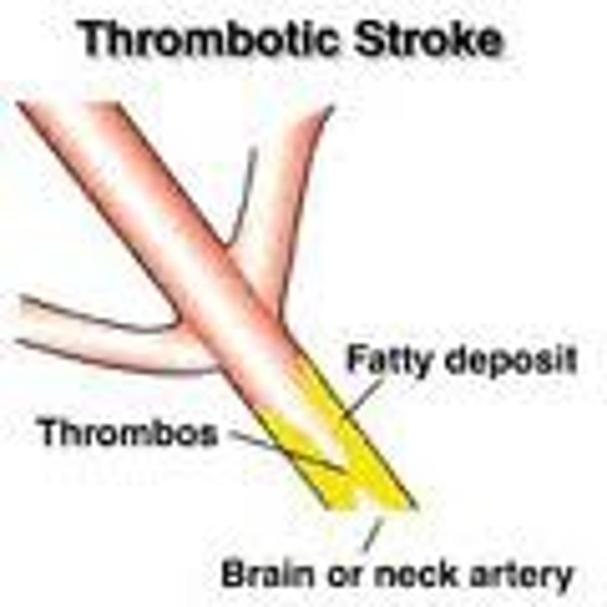 <p>buildup of fatty deposits on the cell wall of the artery, impeding blood flow</p>