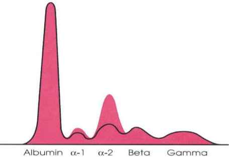 <p>high AAT and haptoglobin</p>