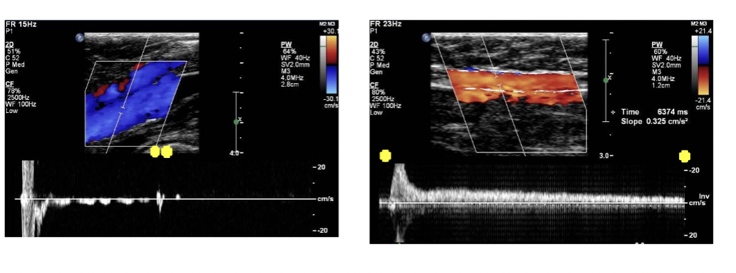 <p>What is the criteria for venous insufficiency ( reflux) </p>