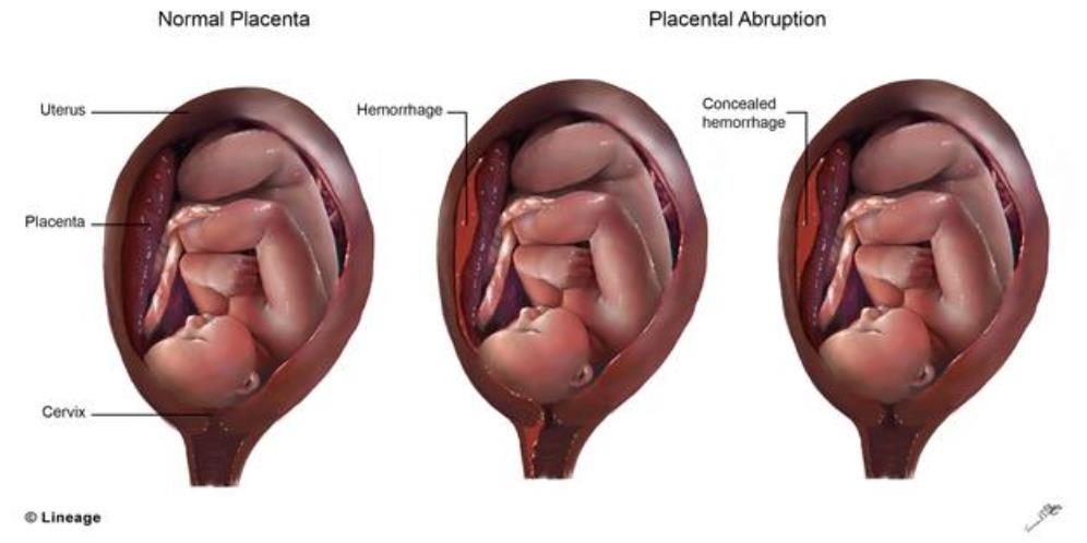 <p>Abruptio placentae</p>