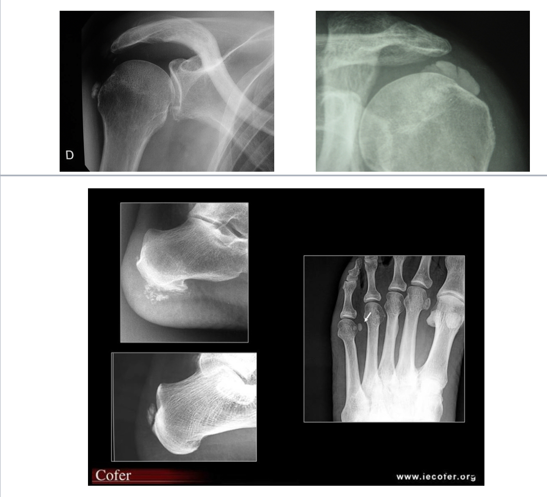 <p>= dépôt dans les structures péri-articulaires (tendons, capsules articulaires et bourses séreuses) de cristaux apatites, généralement épaule, hanche, main, doigts/poignets </p><p>Radio : </p><ul><li><p>Opacité calcique arrondie, homogène, sans corticale </p></li></ul><p></p>