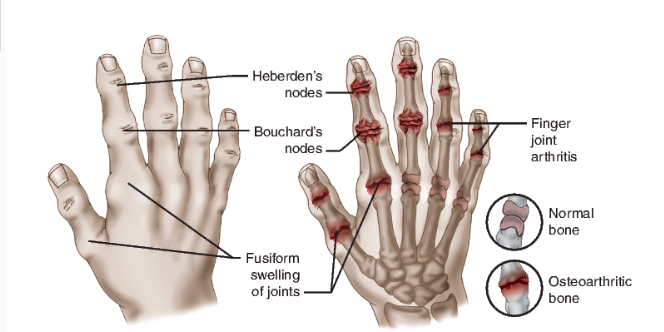 <ul><li><p><strong>OA</strong></p><ul><li><p>Joint pain</p></li><li><p>Joint stiffness</p></li><li><p>Decrease ROM</p></li><li><p>Inflammation</p></li><li><p>Difficulty performing daily activities</p></li><li><p>Visible joint changes</p></li><li><p>Muscle weakness</p></li></ul></li><li><p><strong>RA</strong></p><ul><li><p>Tender, warm, swollen joints</p></li><li><p>Morning stiffness</p></li><li><p>Rheumatoid nodules</p></li><li><p>Fatigue, fever, and weight loss</p></li></ul></li></ul><p></p>