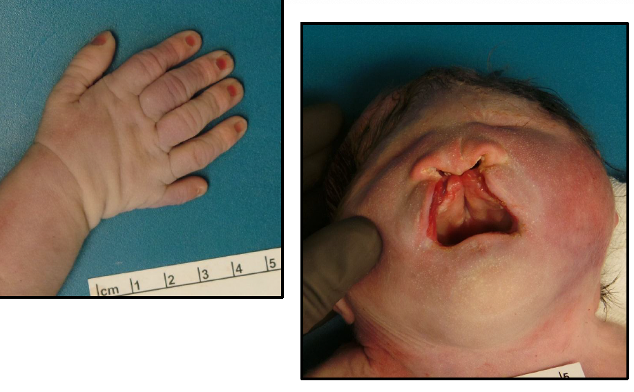 <ul><li><p>microcephaly</p></li><li><p>mental retardation</p></li><li><p>microphthalmia</p></li><li><p>polydactyly</p></li><li><p>cardiac defects</p></li><li><p>umbilical hernia</p></li><li><p>renal defects</p></li><li><p>cleft lip/palate</p></li><li><p>rocker bottom feet</p></li><li><p>**majority die in utero</p></li></ul><p></p>