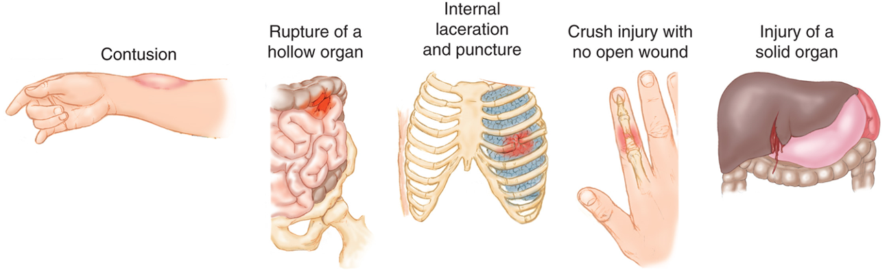 <ul><li><p>Contusions</p></li><li><p>Rupture of a hollow organ</p></li><li><p>Internal laceration and puncture</p></li><li><p>Crush injury with no open wound</p></li><li><p>Injury of a solid organ</p></li></ul><p></p>