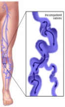 <ol><li><p>Are these veins normal or abnormal?</p></li><li><p>If abnormal, what pathology is seen here?</p></li></ol><p></p>
