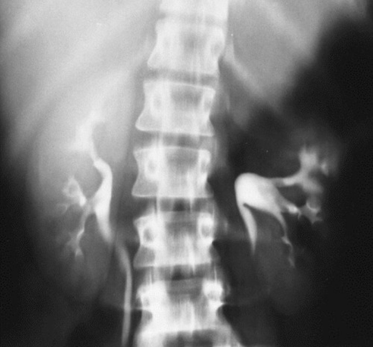 <p>- What type of abdominal neoplasm arises from the adrenal gland (endocrine system) and pushes down on the kidney?</p><p>- This is the _________ most common abdominal neoplasm in whom?</p>