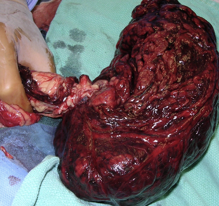 <p>- "C-shape" on R lat abdominal radiograph</p><p>- Best diagnostic: ultrasound w/ color flow doppler</p>