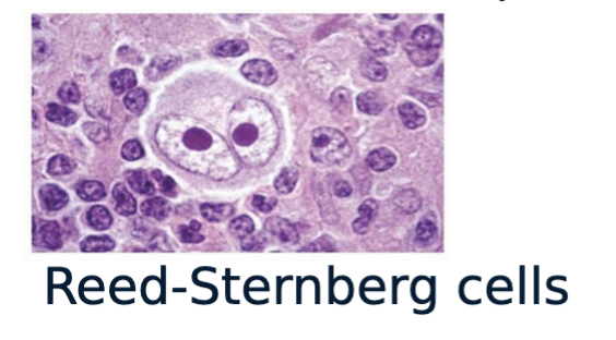 <ul><li><p>A type of lymphoma that is characterized by the presence of Reed-Sternberg cells.</p></li></ul><p></p>