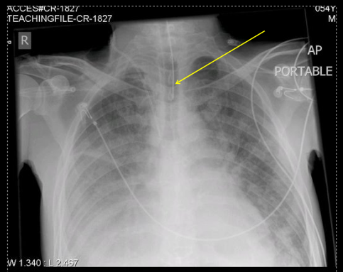 <p>what type of tube is this?</p>