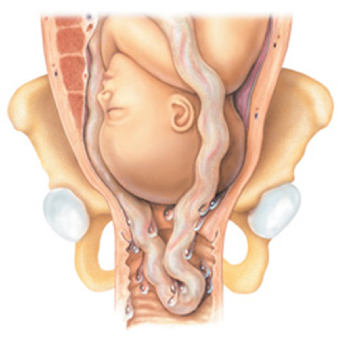 <p>Condition where umbilical cord precedes fetal head in the birth canal.</p><p>Obstetric emergency</p><p>How?</p><p>FHR tracing/pattern</p><p>Severe Bradycardia</p><p>Variable deceleration</p>