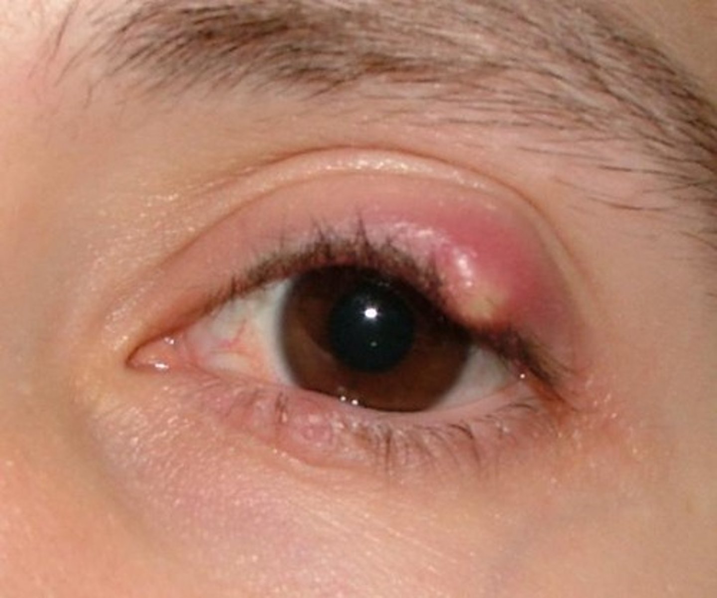 <p>staph infection of a sebaceous gland in the eyelid</p>