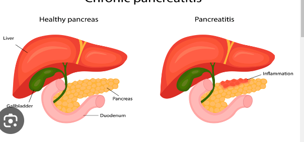 <p><span style="font-family: Droid Sans Mono, monospace">PANCREATITIS</span></p>