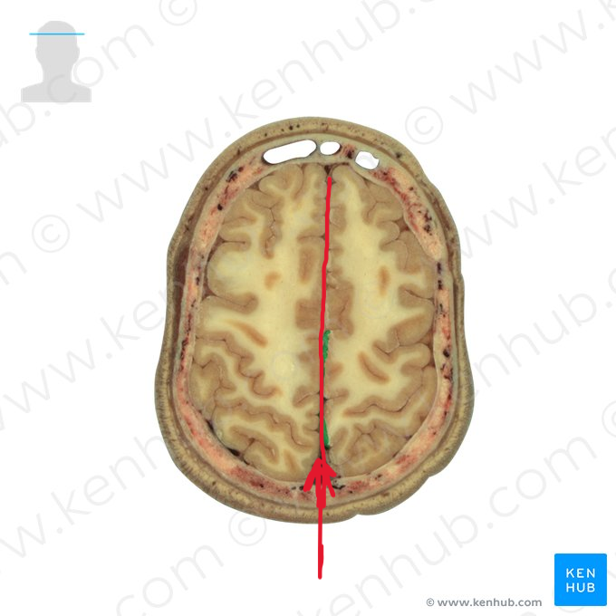 <p>Infolding. Thin sheet separates hemispheres</p>