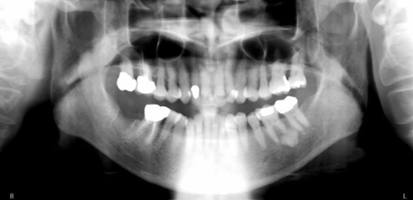 <p>What is the problem that resulted in this image, relating to the occlusal plane?</p>