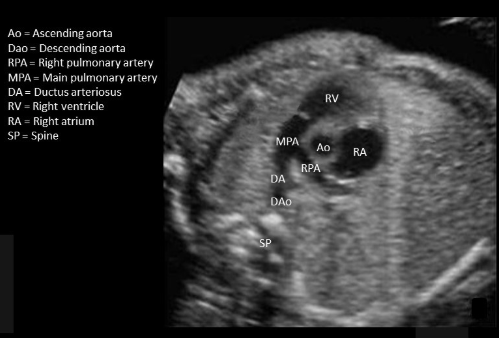 <p>under ductus arteriosus </p>