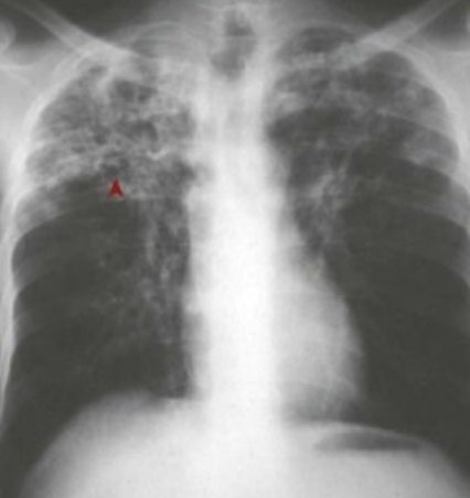 <p>8.8 Side A (PBD9: 371; BP9: 493)<br></p>
<p><br></p>
<p>Questions<br></p>
<p>A 53-year-old homeless man has fever, night sweats, and cough. Chest X-ray is shown.<br></p>
<p><br></p>
<p>1. What infection does he likely have?<br></p>
<p>2. What is the immune mechanism?<br></p>
<p>3. What test would you order on his sputum?<br></p>