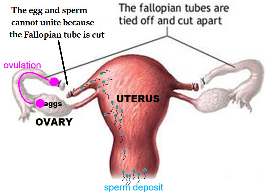 <p>Tubal ligation</p>