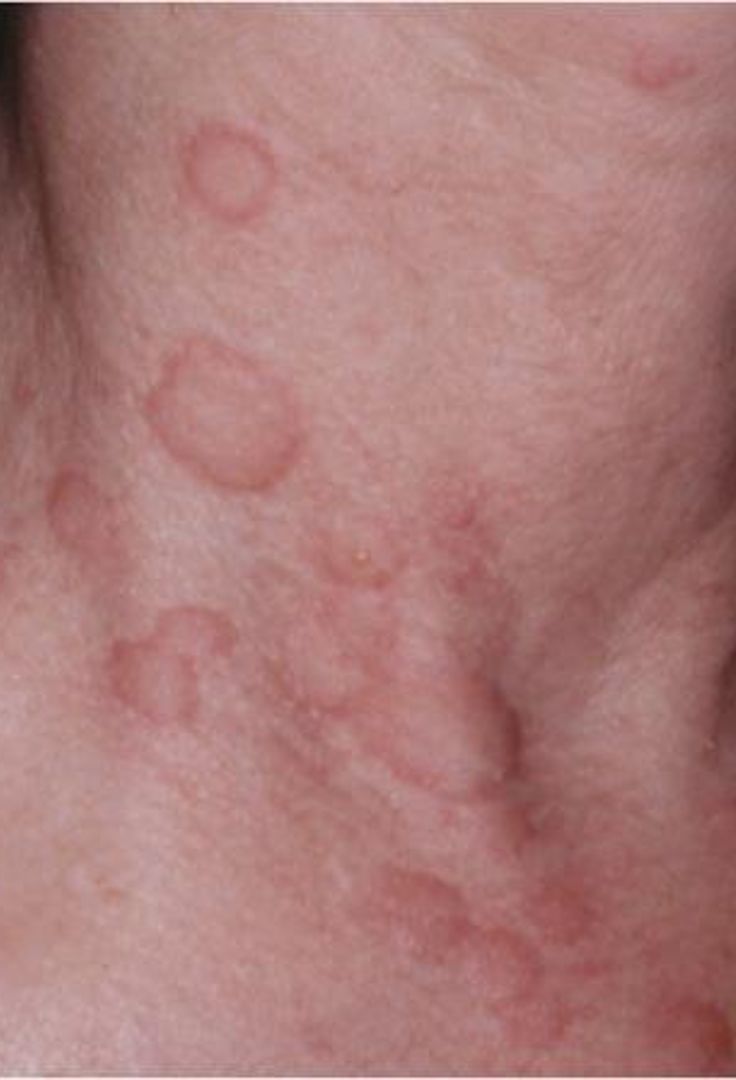 <p>rounded or flat topped edematous plaque that is well demarcated; no scaling or epidermal involvement, color and shape varies </p>