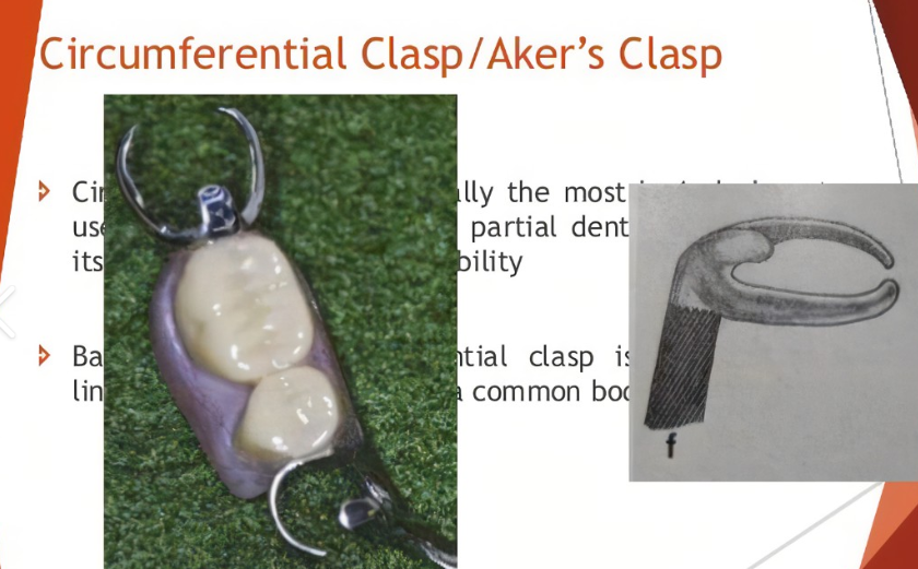 <ul><li><p>often used with tooth-supported partial dentures</p></li><li><p>provides retention and stabilisation </p></li><li><p>considered a logical choice due to effectiveness</p></li></ul><p></p>