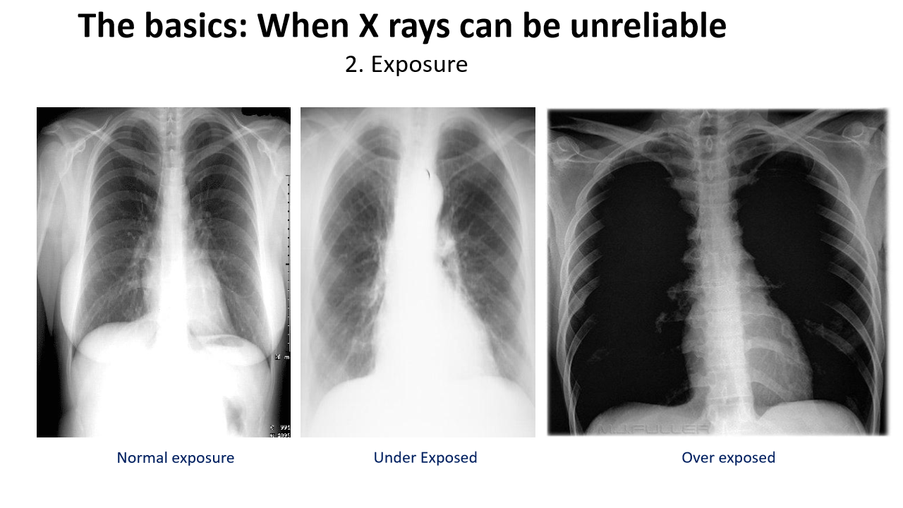 <p>in an (over/under)exposed x ray, people might think that there is too much air and pt has pneumothorax</p>