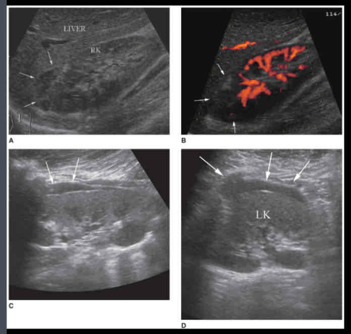 <p>What does the following describe?</p><p><span>• It’s a Collection of blood outside the kidney</span><br><span>• Due to trauma, anticoagulant therapy</span><br><span>• Mass may be palpable; unilateral flank pain</span><br><span>• Decreased hematocrit value</span><br><span>Sonographic appearance-- depending on stage of the bleeding process, varying echo patterns from anechoic to complex masses, with both cystic and solid components</span></p>